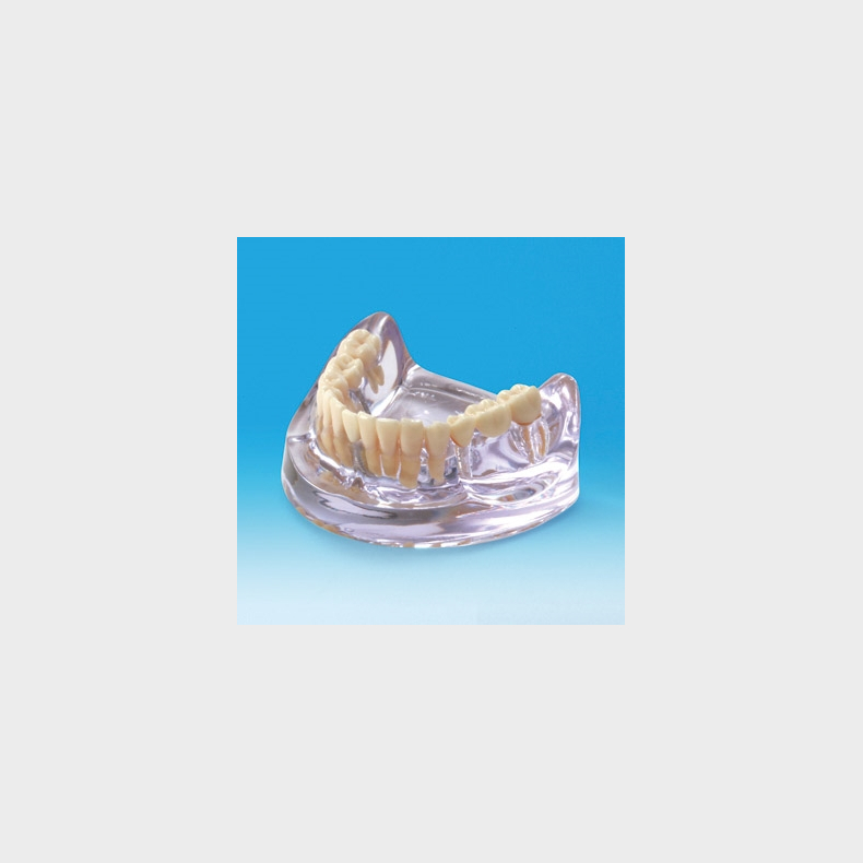 Implantat/Bro Studiemodel 
